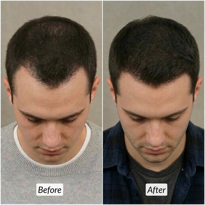 Before and after comparison of a man’s receding hairline and crown thinning showing successful hair regrowth results using Deoxylocks treatments